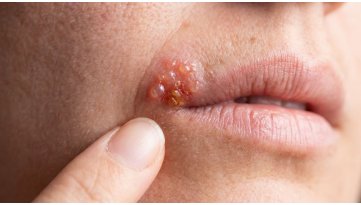 Herpes labiale: cosa fare nelle prime 24 ore