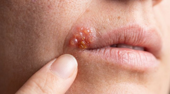 Herpes labiale: cosa fare nelle prime 24 ore
