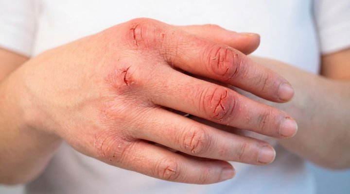 Ragadi alle mani che non guariscono: cause, errori comuni e cosa fare davvero