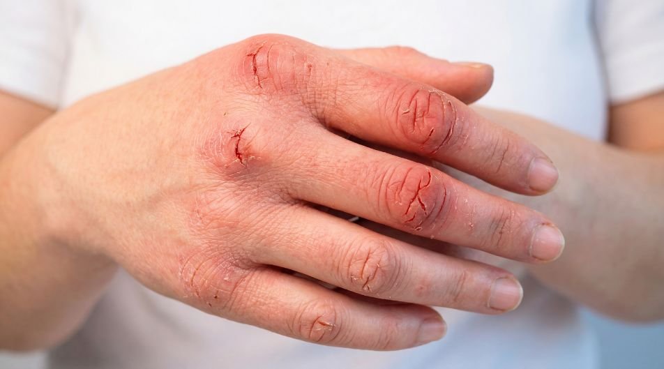 Ragadi alle mani che non guariscono: cause, errori comuni e cosa fare davvero