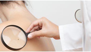 Carcinoma della pelle: prevenzione e controlli da non trascurare