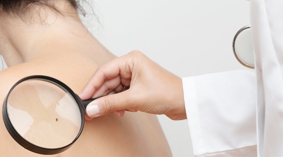 Carcinoma della pelle: prevenzione e controlli da non trascurare Carcinoma della pelle: prevenzione e controlli da non trascurare