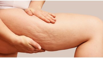 Cellulite e ritenzione idrica: è solo un problema femminile?