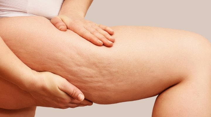 Cellulite e ritenzione idrica: è solo un problema femminile?