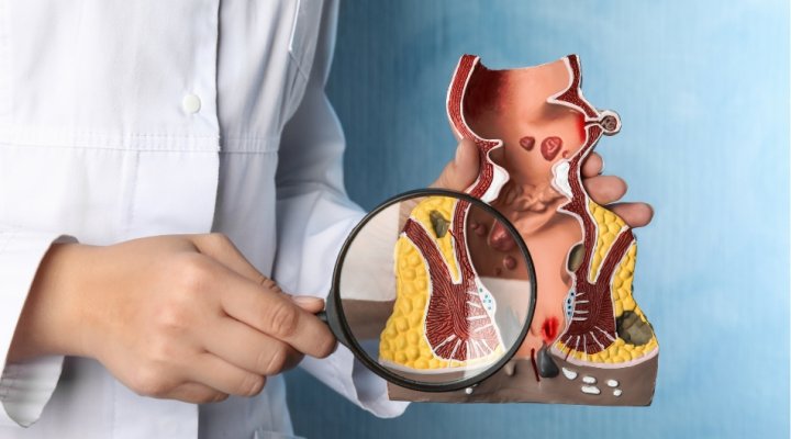 Emorroidi, cause e tipologie